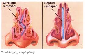Deviated-Septum-Surgery